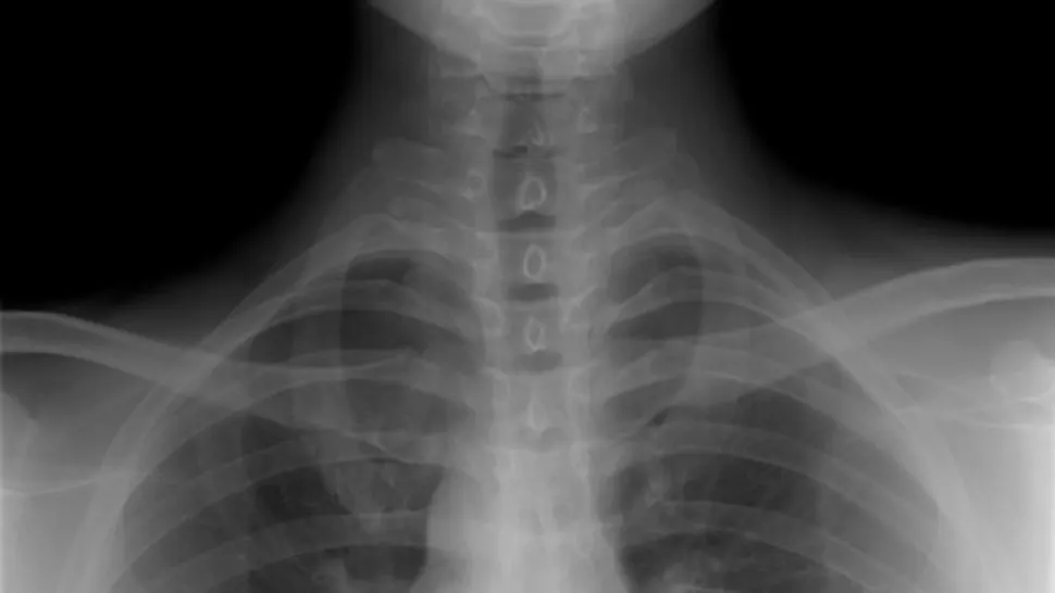 S-a dus la doctor, crezând că are tuberculoză. La analize, medicii au rămas muți!