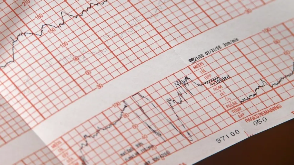 Când este indicată electrocardiograma - EKG? Avertismentul medicilor