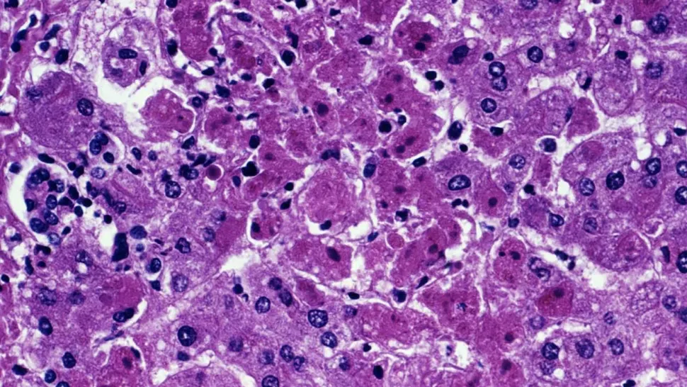 Alertă în Europa: Febra hemoragică Marburg, MORTALĂ, depistată la o persoană care a fost în focarul african - Nu există tratament