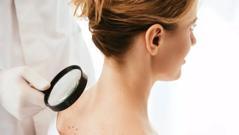 Melanomul, cel mai agresiv cancer de piele. Cine sunt persoanele care riscă cel mai mult să dezvolte boala