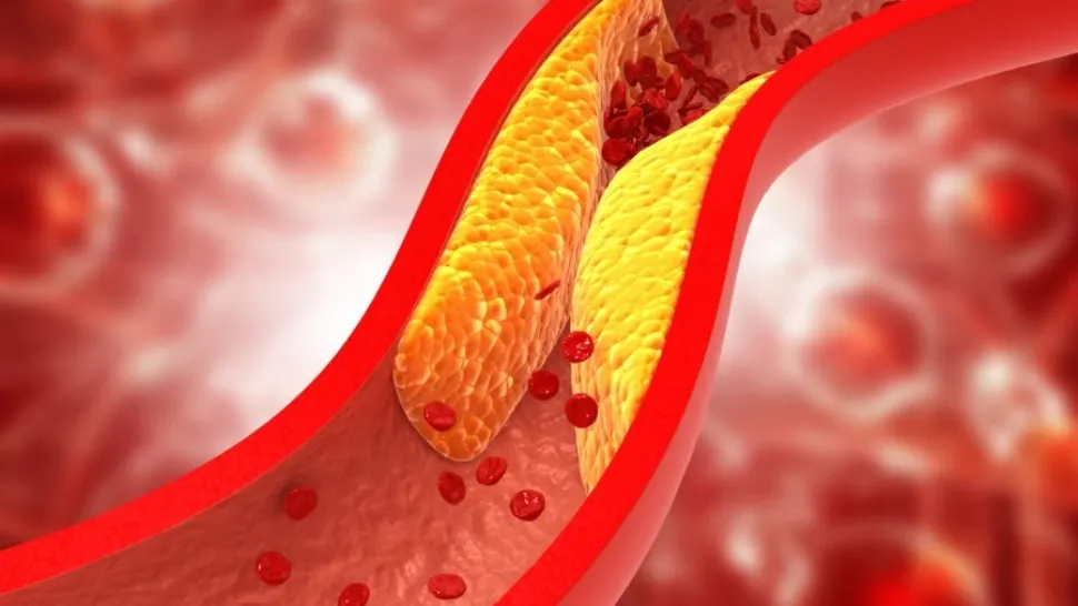 Terapia care reduce colesterolul cu aproape 50%
