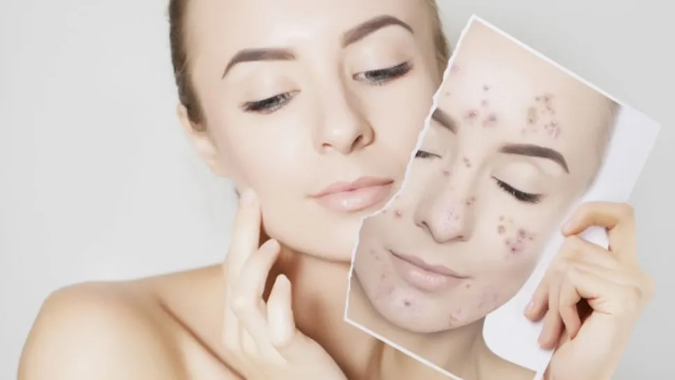 Trucul natural care te scapă de acnee