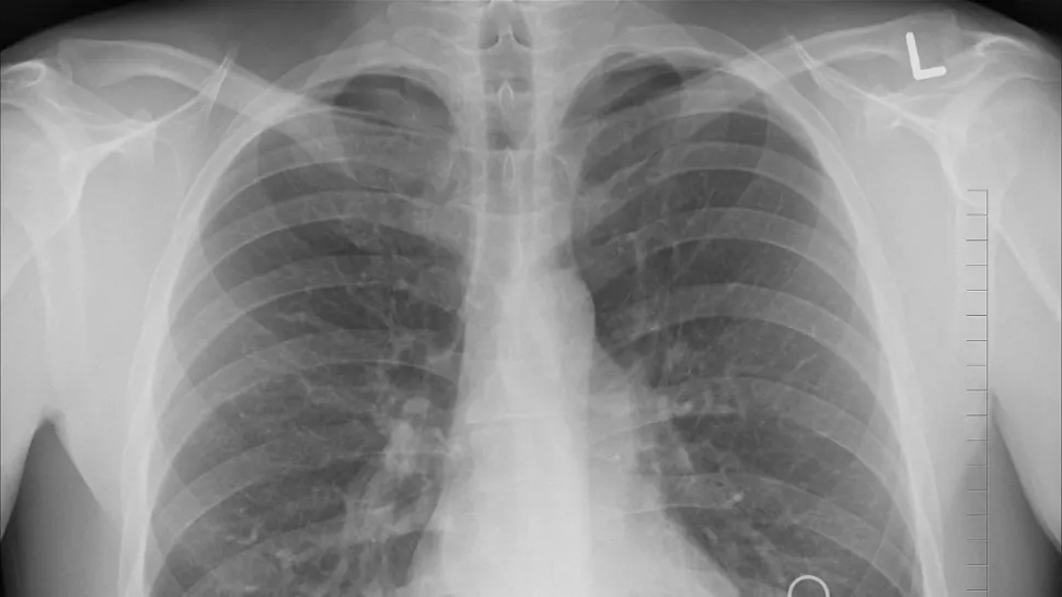 Ce este și cum se transmite „boala legionarilor”. Epidemie: cinci morți și peste 100 de cazuri confirmate