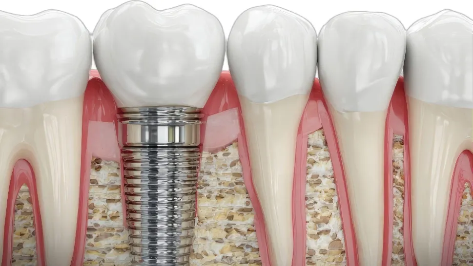 Implant dentar