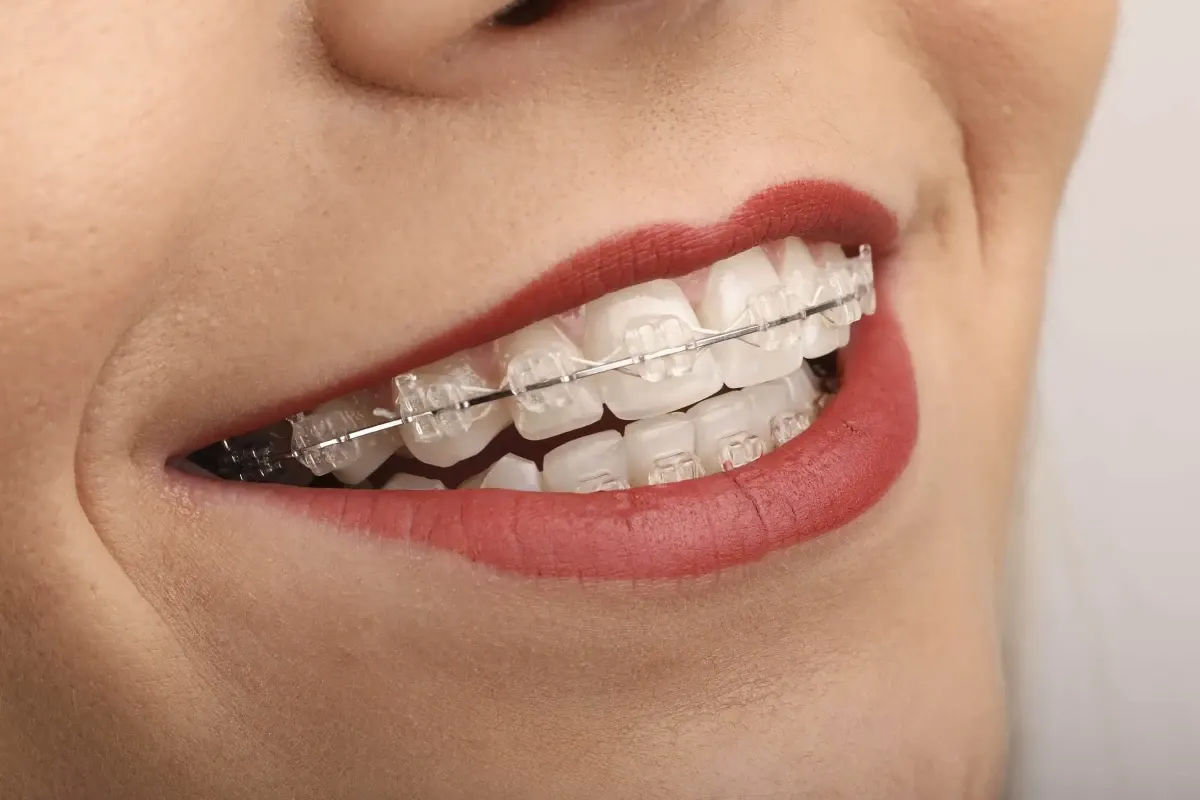 Aparat dentar