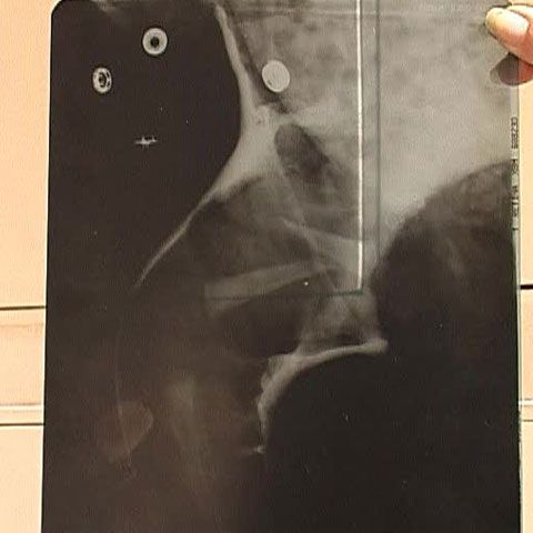 Părinţii unui bebeluş din Galaţi susţin că medicii le-au ascuns faptul că băieţelul avea o fractură de femur