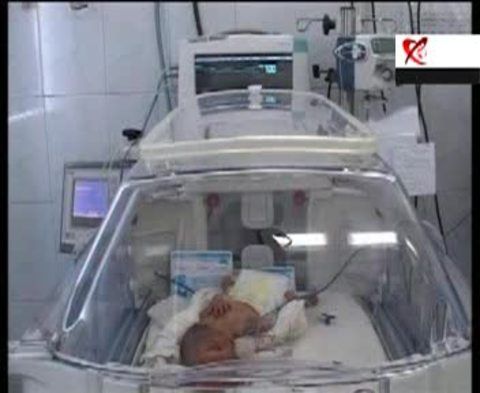 Doi fraţi siamezi din Braşov, uniţi în zona capului, au încetat din viaţă