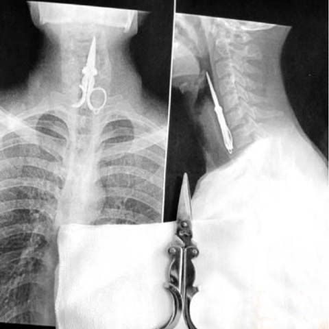 Un chinez a ajuns la spital cu o forfecuţă de unghii înfiptă în esofag