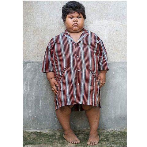 O fetiţă din India cântăreşte 76 de kilograme la doar 5 ani