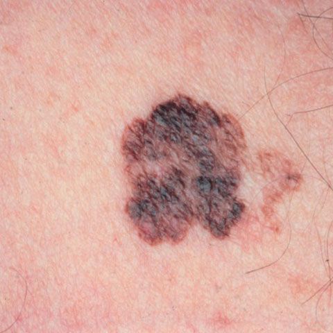 Un nou medicament testat pentru tratarea melanomului s-a dovedit eficient în reducerea tumorilor