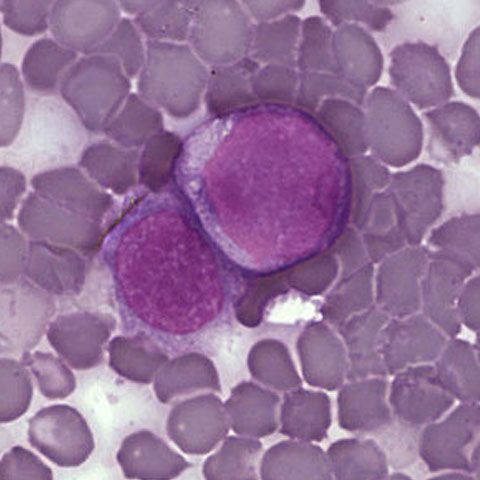 Bolnavii de cancer solicită desfiinţarea listelor de aşteptare pentru pacienţii cu leucemie mieloidă