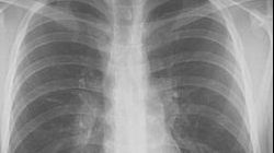 Primele semne ale cancerului pulmonar ar putea fi detectate cu ajutorul unui test respirator -studiu