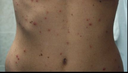 Ce se întâmplă dacă ieşi afară când ai varicelă? Atenţie! E mai rău decât crezi