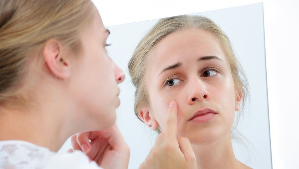 Cum scapi DEFINITIV de ACNEE