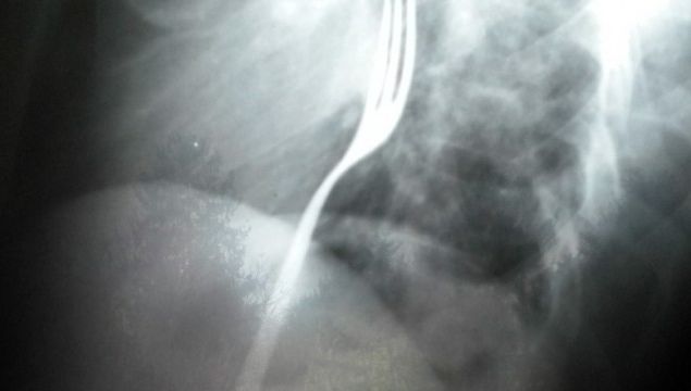 Un bărbat a ajuns la URGENŢE, după ce a înghiţit O FURCULIŢĂ