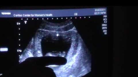 STUDIU: Primele indicii ale autismului apar în timpul sarcinii