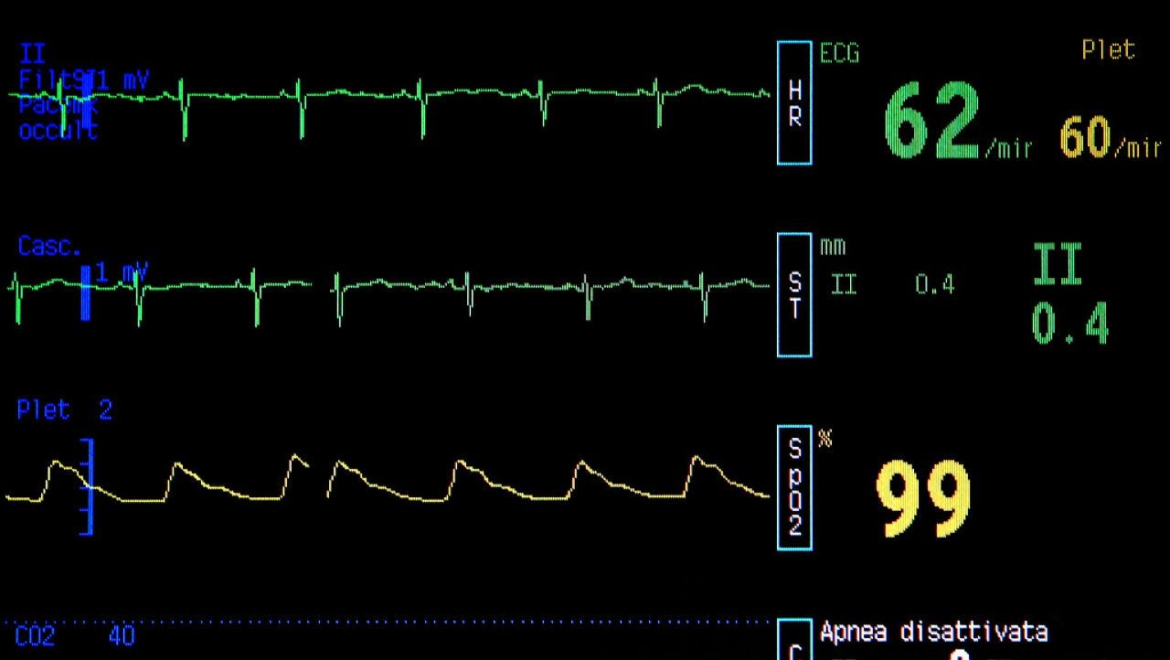 Şi-a deconectat soţia de la aparate, pe patul de spital. După trei zile a primit o veste ŞOCANTĂ