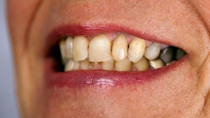 Cum să cureţi piatră de pe dinţi chiar la tine acasă! E simplu şi sănatos! 