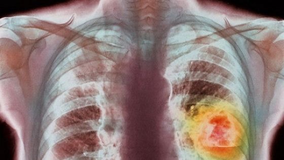Descoperire medicală de ultimă oră: Alimentul care ucide 85% din celulele cancerului pulmonar