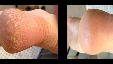 Scapă de călcâiele crăpate cu un amestec uimitor