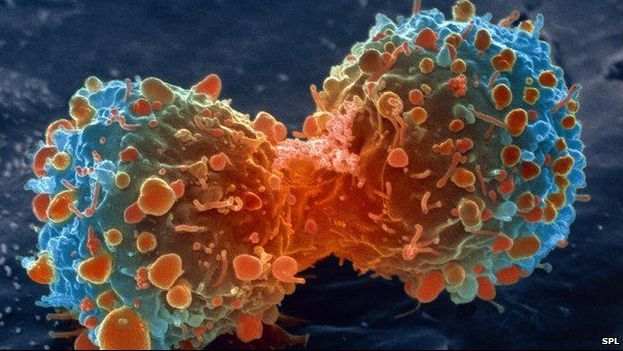 S-a lansat un program pe calculator care îţi spune dacă ai cancer. Iată cum funcţionează