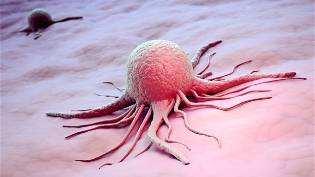 Semnal de alarmă! Prea mulţi români mor din cauza cancerului gastric. Primele simptome