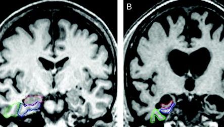 Descoperire surprinzătoare. Ce au văzut medicii în creierul unui bolnav de Alzheimer