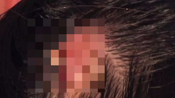 Se scărpina mereu în cap. A rămas stupefiată după ce a fost la medic și i-a scos asta din scalp