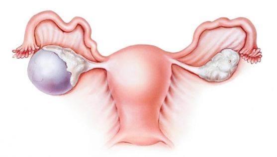 Cauza nebănuită a cancerului ovarian. Multe femei se îmbolnăvesc din cauza acestui produs