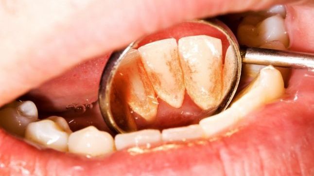Fără dentist. E clar: aceasta este cea mai eficientă metodă de îndepărtare a tartrului