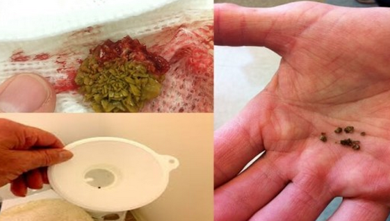 Remediul miraculos care îţi curăţă rinichii! Nu vei mai avea niciodată probleme cu pietrele