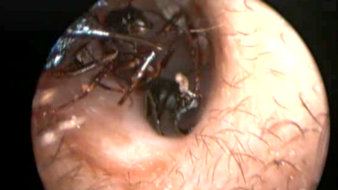 Ceva se mișca în urechea fetiței și s-au apropiat să vadă. Apoi, ȘOC, au început să iasă cu sutele