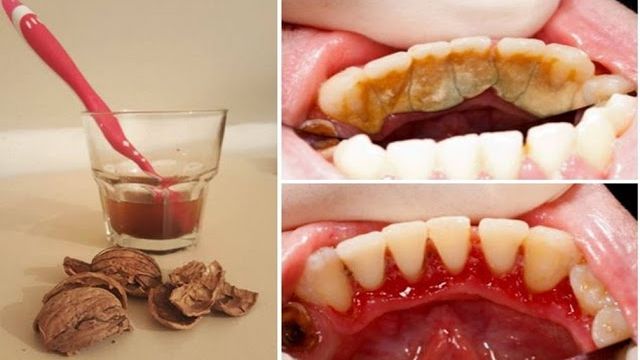 Scapi rapid de tartru cu ajutorul unui singur ingredient!