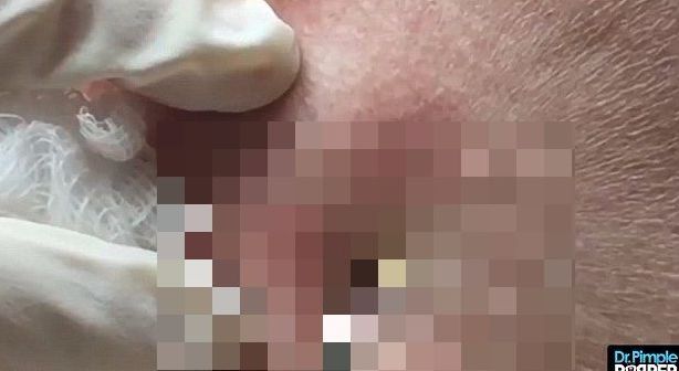 Nu-și putea întoarce capul din cauza unei umflături. A spart-o! Ce-a ieșit l-a lăsat fără cuvinte