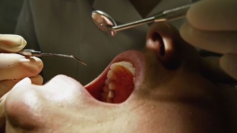 S-a dus la dentist să-şi scoată măselele de minte. Totul s-a transformat însă, într-un coşmar!