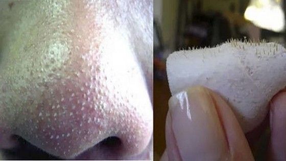 Cum scapi de punctele negre de pe nas cu o bucată de vată. Trucul pe care-l folosesc cosmeticienele