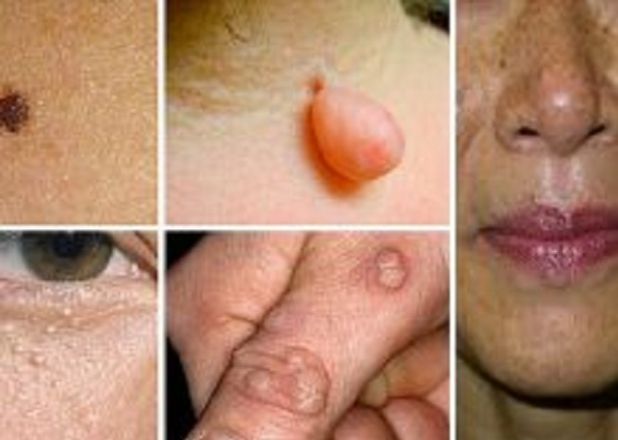 DESCOPERIRE: Este probabil cel mai eficient remediu natural pentru alunițe și negi