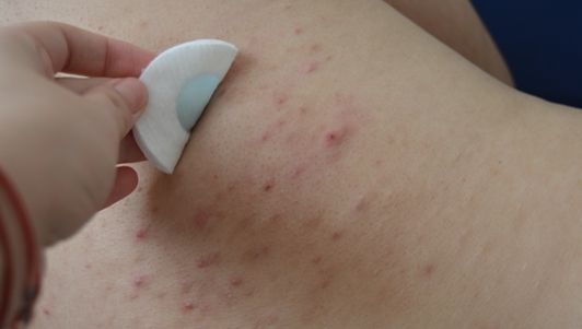 Iţi apar coşuri pe spate? Mare atenţie! Ai putea suferi de această boală