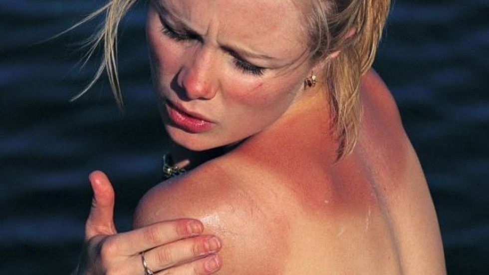 10 remedii naturale pentru calmarea arsurilor solare. Scapi imediat de usturime şi durere!