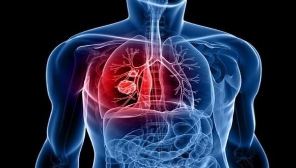 Acesta este alimentul care ucide 85% din celulele cancerului pulmonar