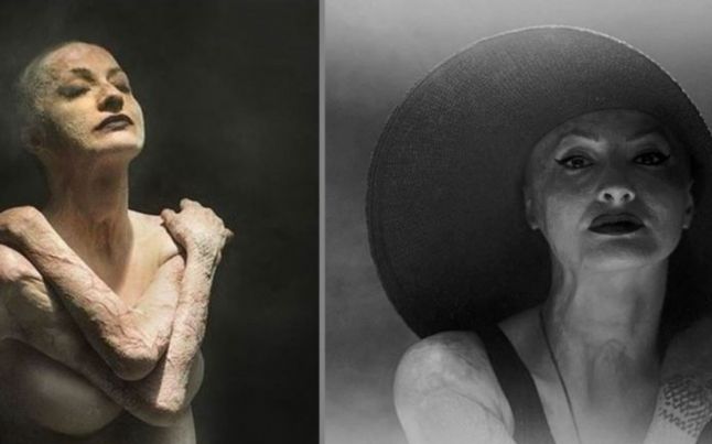 Rănile de la COLECTIV se văd. Expoziţia care arată cicatricile de pe trupul unei supravieţuitoare 