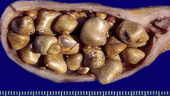 Remediul secret care te scapă de pietrele la fiere în 7 zile!