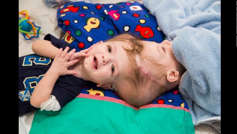 Povestea emoţionantă a siamezilor uniţi în jurul craniului. Cum au reacţionat după ce s-au văzut 