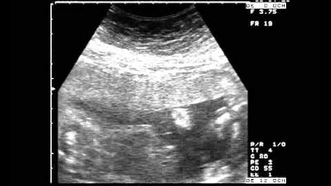 I-au spus că fătul are malformații grave. A refuzat avortul. Șoc la naștere! "Arătați-mi copilul!"