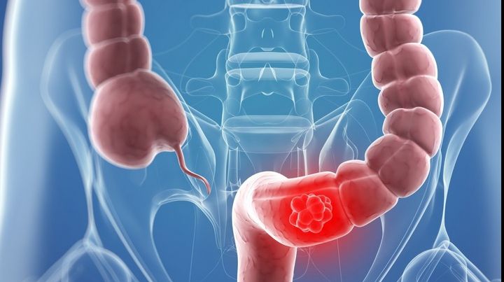 Alarmant! Anul în care te-ai născut îţi spune cât de predispus eşti la CANCERUL de colon