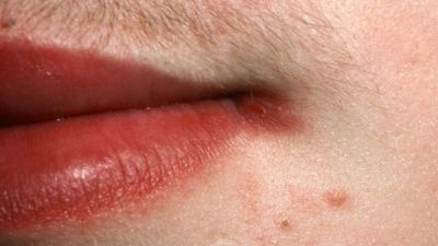 Îţi apar constant crăpături în colţul gurii? Iată cu ce afecţiuni se confruntă corpul tău 