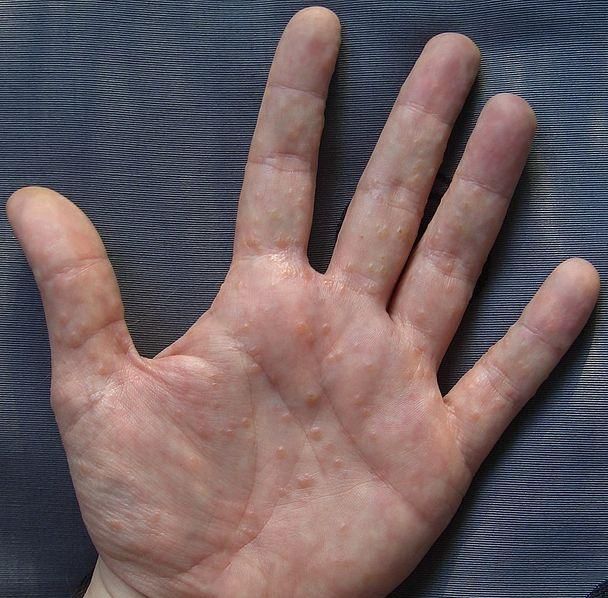10 semne timpurii și adesea ignorate ale celui mai agresiv tip de cancer