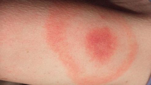 Primele semne că ai fost mușcat de căpușă! Mergi de urgenţă la medic dacă îţi apare asta pe piele