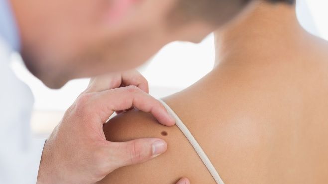 4 lucruri surprinzătoare care pot cauza apariţia cancerului de piele