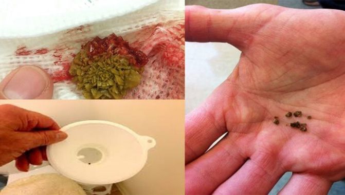 A încercat acest remediu pentru a-şi curăţa rinichii de toxine. Iată ce a păţit după 4 zile!